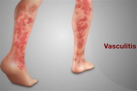 Vasculitis: tünetek, okok és kezelés - Orvos 24