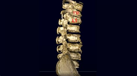 T12-L1 Compressive Fracture 제 12 흉추, 1 요추 압박 골절 - YouTube