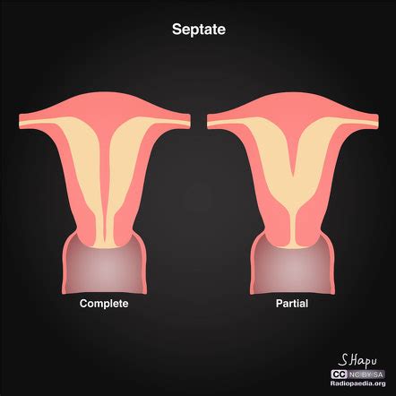 Apendicitis Causas Sintomas E Tratamento