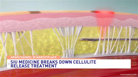 SIU Medicine explains Cellulite Release Treatment