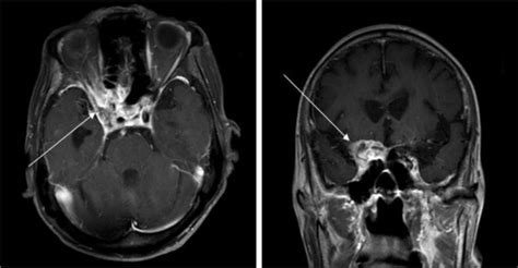 MRI revealing a mass in the right cavernous sinus, exte | Open-i