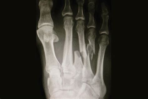 3Rd Metatarsal Fracture Healing Time / Toe And Forefoot Fractures ...