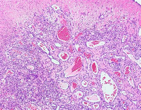 Pyogenic Granuloma Lips Pathology Outlines | Lipstutorial.org