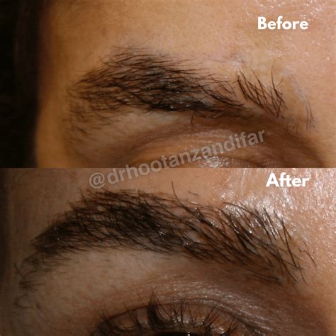 Eyebrow Transplant Procedure Beverly Hills and Los Angeles CA