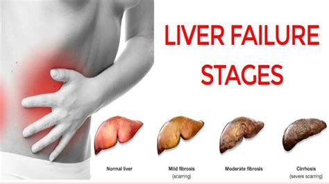 6 BEST HOME REMEDY FOR LIVER FAILURE - Health GadgetsNG