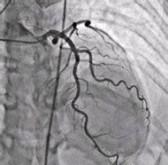 Coronary Angiography: Definition, Heart Angiogram Test, Procedure ...