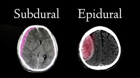 Subdural Hematoma And Epidural Hematoma Ems Related Not For Faint Of ...