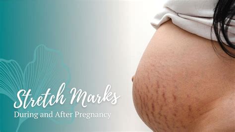 Stretch Marks During Pregnancy | Stork Helpers