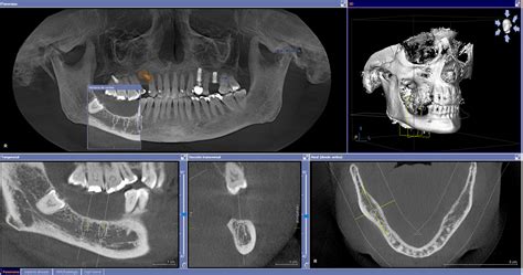 Aptitud Oceano conformidad diferencia entre cone beam y tac estático ...