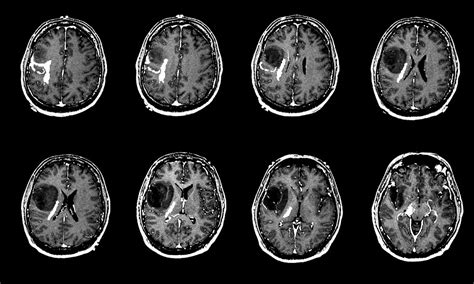 Brain MRI Tumor Detection with Convolutional Neural Network | by ...