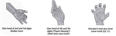 Hand Of Benediction Vs The Claw Hand The Ulnar Paradox] | atelier-yuwa ...