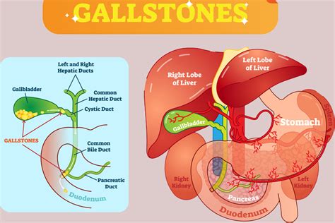 Coding Gall Stones: Symptoms & Treatment Overview