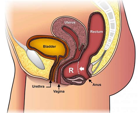 Pessary for uterine prolapse, pessary fitting, insertion, care, removal ...