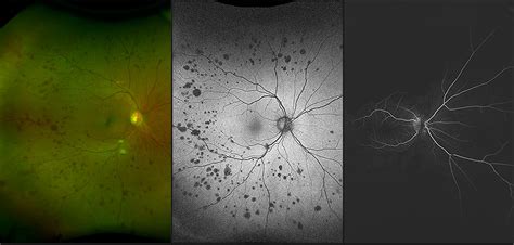 California - Ocular Ischemic Syndrome, RG, AF, FA