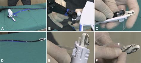 Step-by-step approach to endoscopic gastroplasty by a novel single ...