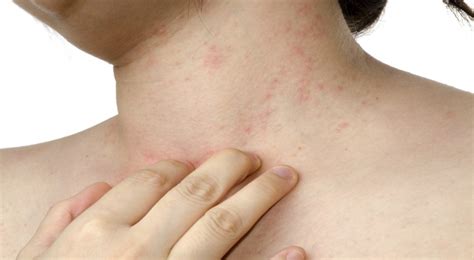 What is Smallpox? Symptoms, Causes, Risk Factors and Diagnosis ...