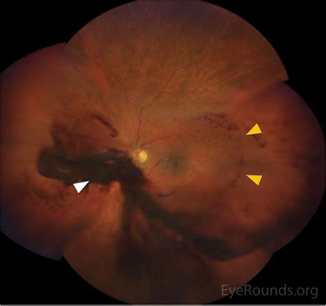 EyeRounds.org: Ocular Ischemic Syndrome