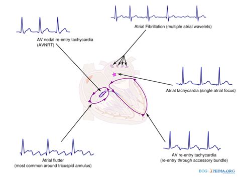 Supraventricular Rhythms - ECGpedia