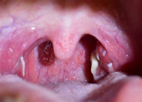 Can Sinus Drainage Cause Tonsil Stones - Best Drain Photos Primagem.Org