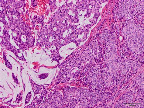 Microscopic appearance of the left total mastectomy specimen. Mainly ...