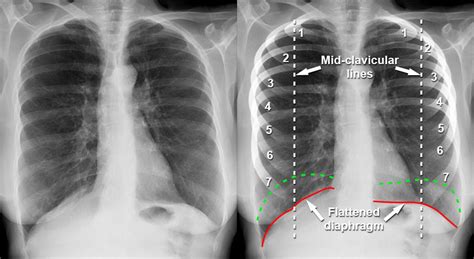 Copd On Chest X Ray