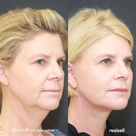 Mini Facelift vs. Full Facelift: What’s the Difference? | Sagging skin ...