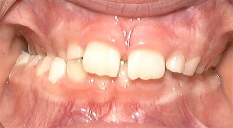 Truman Orthodontics: Unilateral Crossbite With a Functional Shift