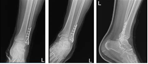 Case Study: ORIF: Lateral Malleolus using Distal Fibula Plate and ...