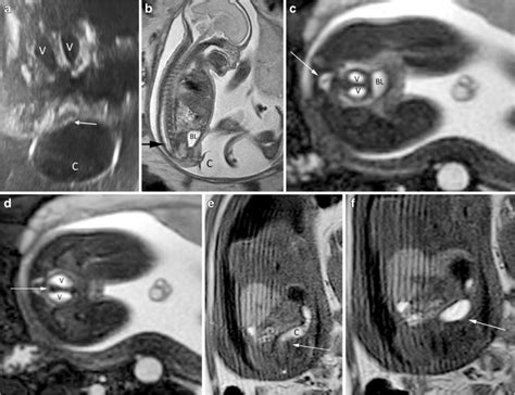 Persistent/classic cloacal malformation with perineal cyst at 25 weeks ...