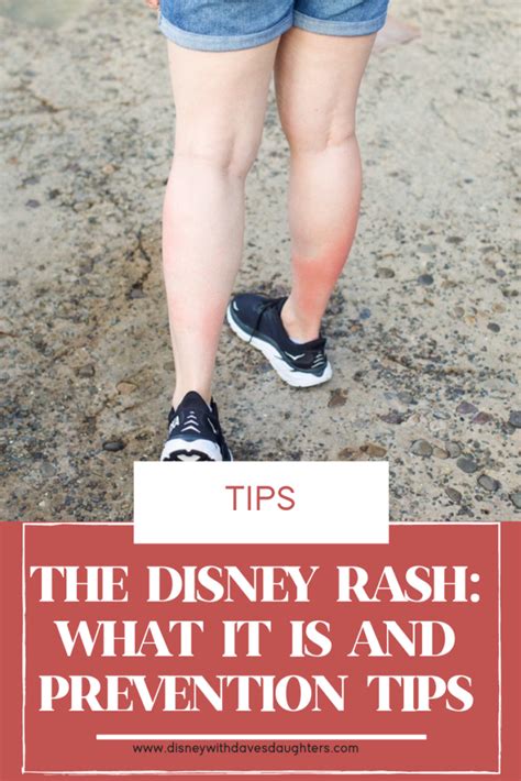 The Disney Rash Is Real! How to avoid and treat it.