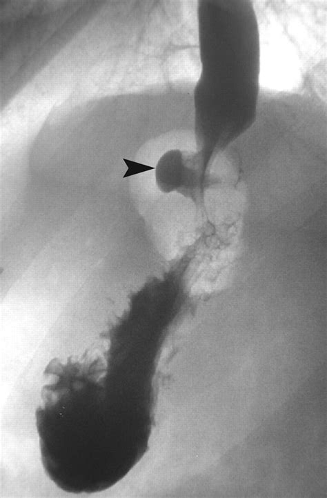 Complications Of Adjustable Gastric Banding, A Radiological, 55% OFF