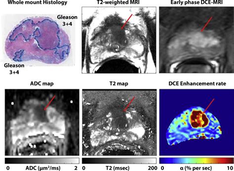 Future Perspectives in Multiparametric Prostate MR Imaging | Radiology Key