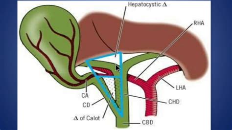 Calot's triangle(hepatobiliary triangle) and hepatocystic triangle ...