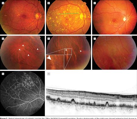 Clinical evaluation of 3 families with basal laminar drusen caused by ...