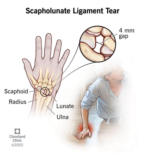 Wrist Sprains: Symptoms, Causes & Treatment