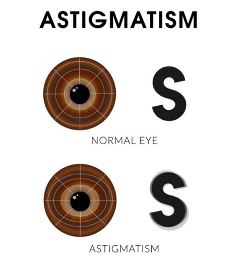 Astigmatism - Symptoms, Causes & Treatment | Lions Eye Institute