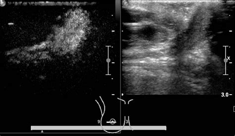 Figure 1 from Breast BI-RADS 3-4 lesions: diagnostic value of ...