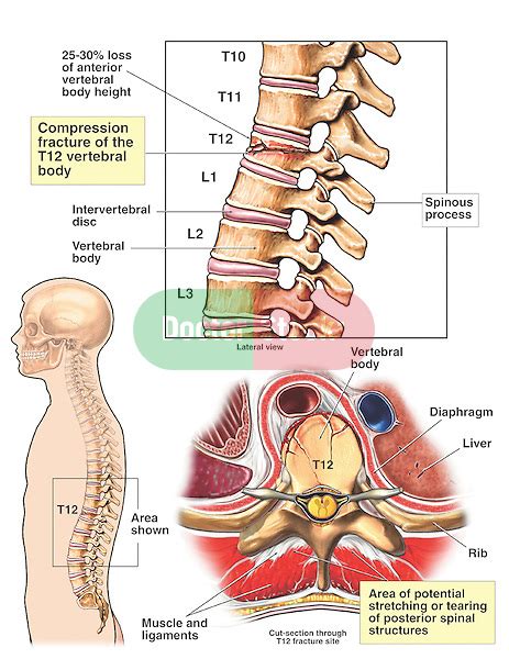 Compression Fracture of the T12 Vertebral Body | Doctor Stock