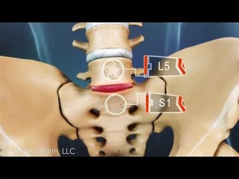 back pain relief l5-s1 - YouTube