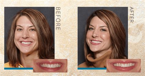 How Jacquelynn Got a Wider Smile [VIDEO] - Gorman Center for Fine Dentistry