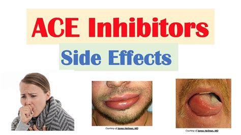 ACE Inhibitor Side Effects: Lisinopril, Ramipril, Captopril ...