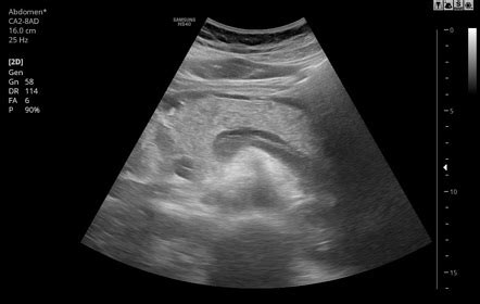 Pancreas Ultrasound