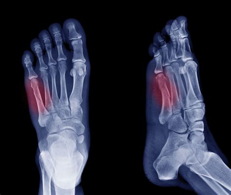 Jones Fracture of the Foot: Symptoms, Treatment, and Recovery