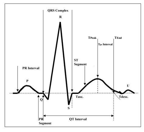 Normal ECG highlighting the common parameters measured when assessing ...