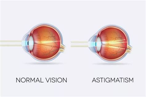 What Is Astigmatism And Its Cause Symptom And Effect | Images and ...