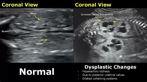 Kidney Ultrasound Images Abnormal