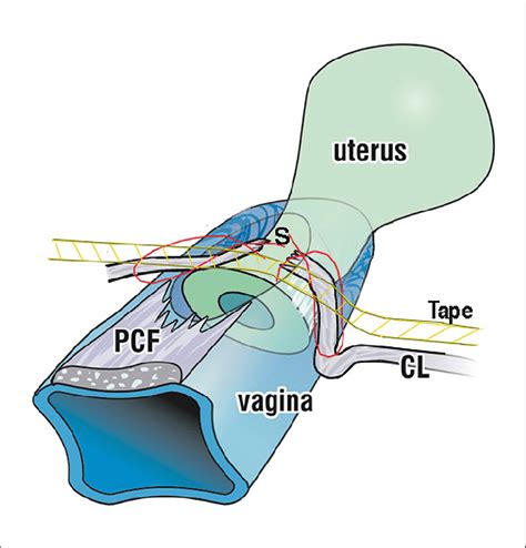 Cardinal Ligament