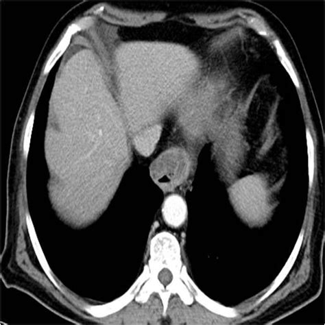 Mucinous Adenocarcinoma of Stomach