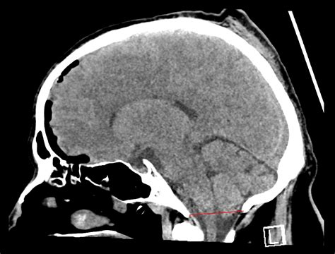 Foramen magnum - Ars Neurochirurgica