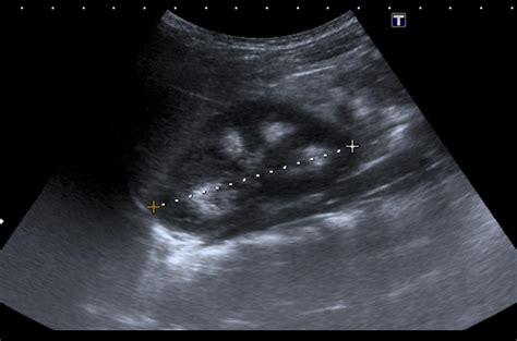 Medullary nephrocalcinosis: Ultrasound - Sumer's Radiology Blog